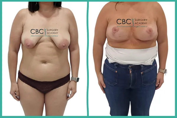 Antes y Después: Cirugía de mamas tuberosas y refinamiento de surco en CBC Academy.