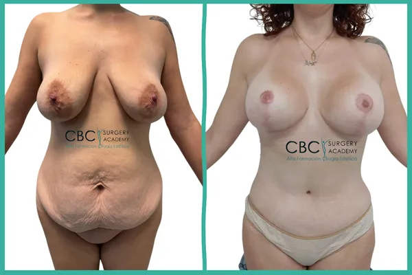 Antes y Después: Mommy Makeover 360, reparación de hernia y nutrición personalizada en CBC Academy.