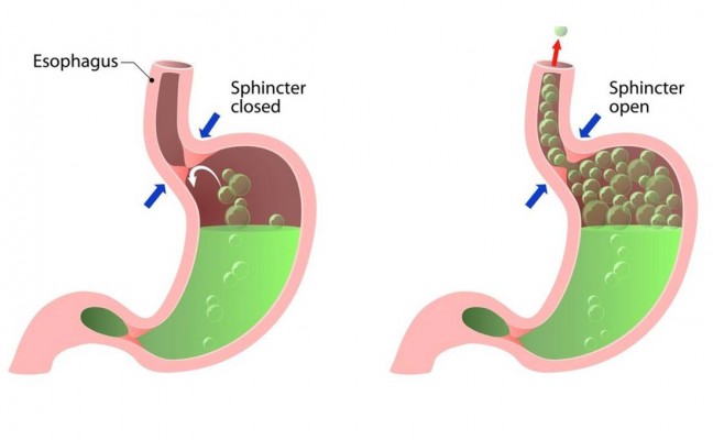 stomach acid