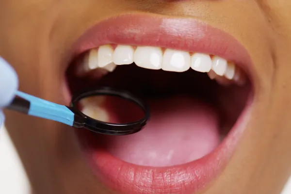 How Acid Reflux Affect Your Oral Health?