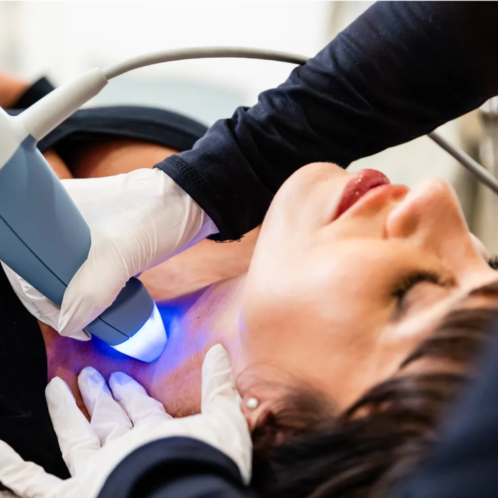 RF microneedling treatment using Exion technology with topical EXO|E exosome application