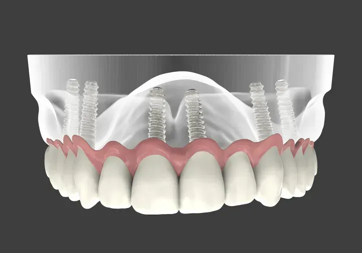 Dental Implants Cost