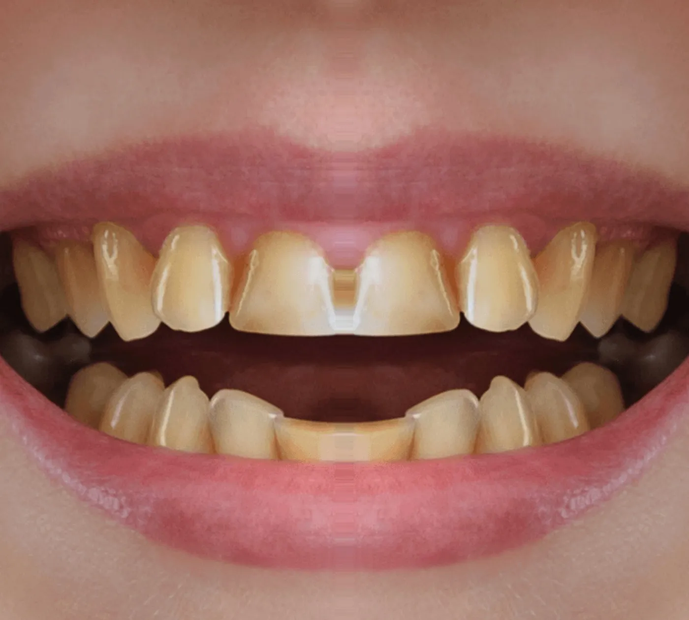 Sonrisa antes del tratamiento: dientes amarillos y desgastados