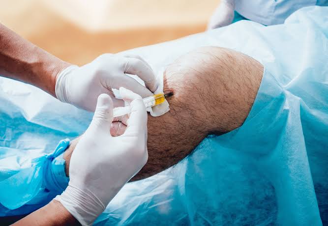 PRP Therapy – Image 1