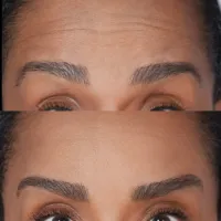Dysport + FREE Cleanser – Image 2