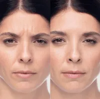 Dysport + FREE Cleanser – Image 3