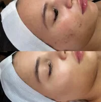 Microneedling + Pore Treatment – Image 2