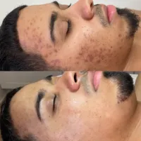 Microneedling + Pore Treatment – Image 3