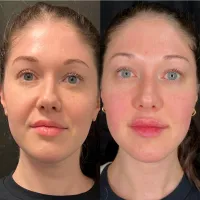 Filler | $150 OFF – Image 2