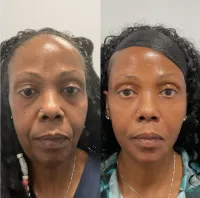 Facial Balancing Package – Image 3