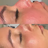 HydraFacial + Dermaplane Package – Image 4