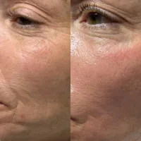 HydraFacial + Dermaplane Package – Image 2