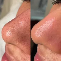 HydraFacial + Dermaplane Package – Image 3