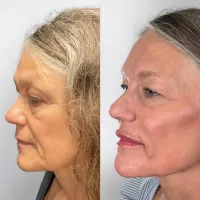 Facial Balancing Package – Image 2