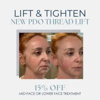 PDO Lifting Threads – Image 1