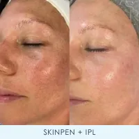 Laser Skin Duo – Image 2