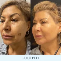 Laser Skin Duo – Image 4