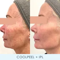 Laser Skin Duo – Image 3