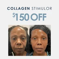 Sculptra® | $150 OFF – Image 1