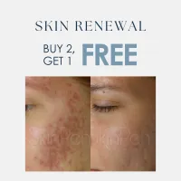 SkinPen® | Buy 2, Get 1 FREE – Image 1