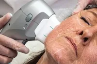HIFU Treatment – Non-Surgical Lift, Fat Reduction & Skin Tightening (THREE AREAS) – Image 1