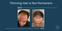 Hair Restoration Phases 2 & 3 with BPC-157 & Copper Peptides – Image 3