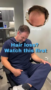 Hair Restoration Phases 2 & 3 with BPC-157 & Copper Peptides – Image 2
