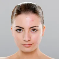 Acne Facial – Image 1