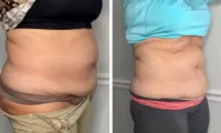 Buy 6, get 6 FREE- 5D Lipo Laser – Image 9