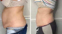 Buy 6, get 6 FREE- 5D Lipo Laser – Image 10