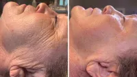 3-RF Microneedling – Image 5
