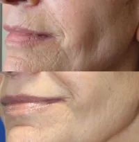 3- RF Skin Tightening Facials  – Image 2