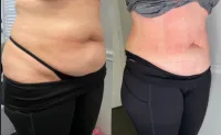 Buy 6, get 6 FREE- 5D Lipo Laser – Image 4