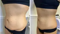 Buy 6, get 6 FREE- 5D Lipo Laser – Image 7