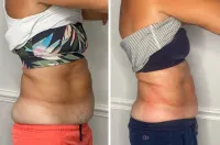 Buy 6, get 6 FREE- 5D Lipo Laser – Image 8