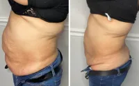 Buy 6, get 6 FREE- 5D Lipo Laser – Image 6