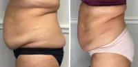 Buy 6, get 6 FREE- 5D Lipo Laser – Image 5