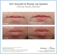 SkinMedica HA5® Smooth & Plump Lip System – Imagen 2