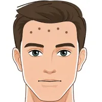 Frente Botox Él – Imagen 1