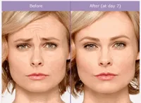 Forehead Wrinkle Eraser - Botox® – Image 3