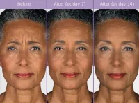 Forehead Wrinkle Eraser - Botox® – Image 4