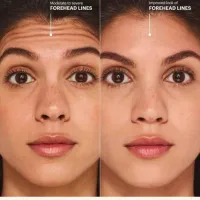 Forehead Wrinkle Eraser - Botox® – Image 2