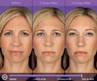 Forehead Wrinkle Eraser - Botox® – Image 5