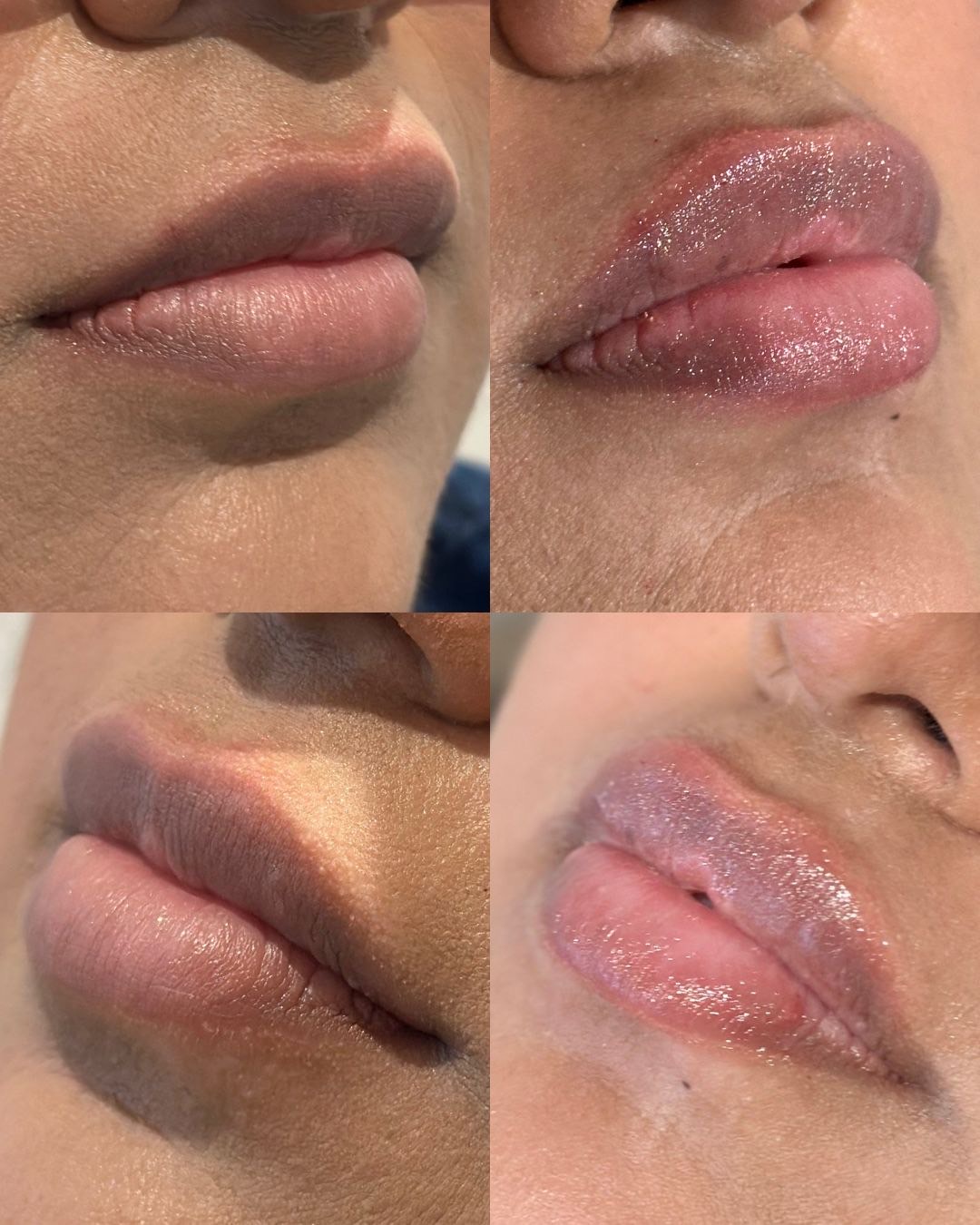 Lip Flip – Image 4