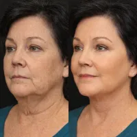  Microneedling | SkinPen® – Image 6