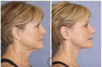 Sculptra® – Image 7