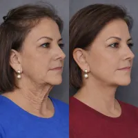 Sculptra® – Image 5