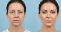  Microneedling | SkinPen® – Image 5