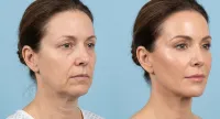 Sculptra® – Image 3