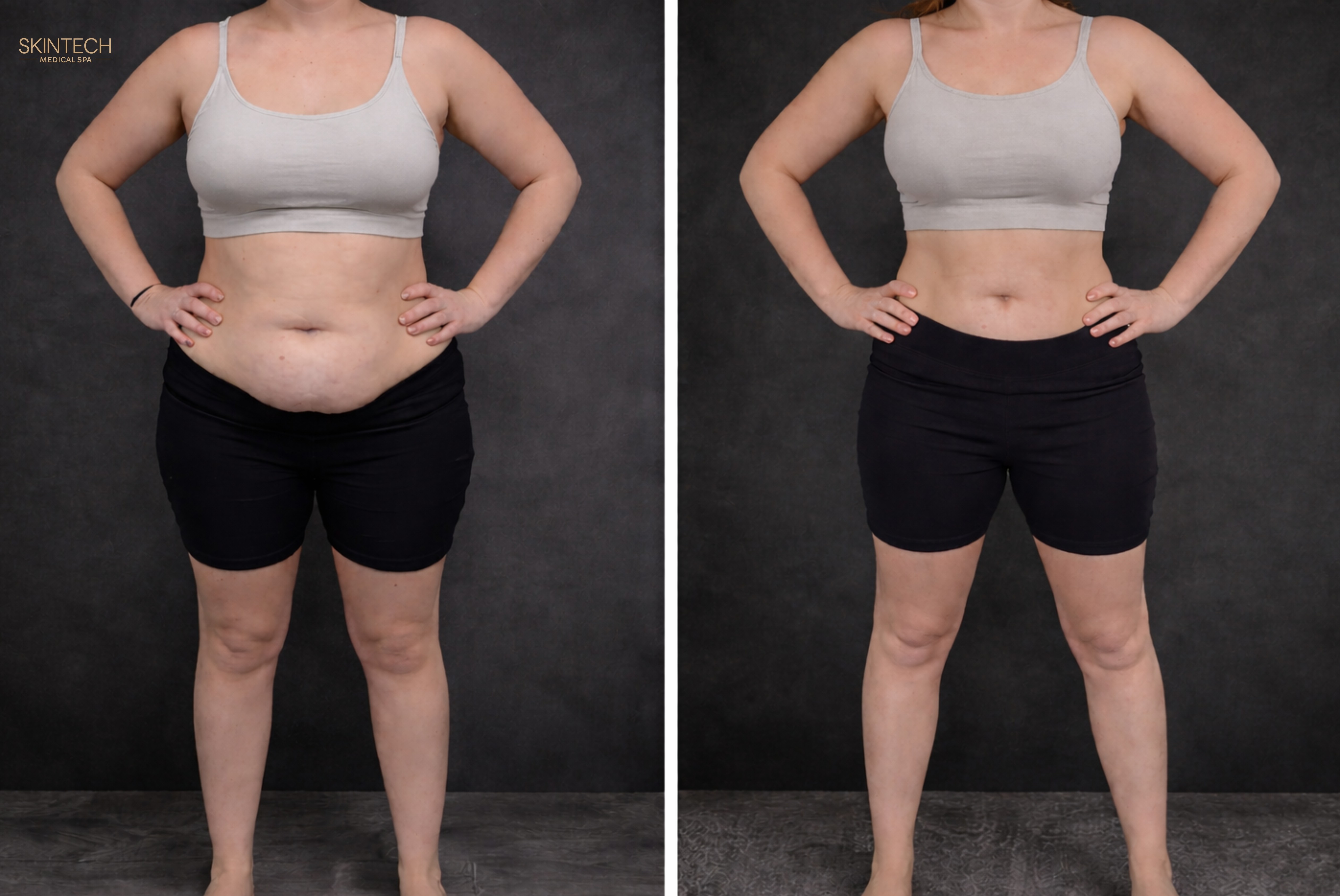 Mid-Section Makeover - Body Contouring (Bionexis) – Image 4